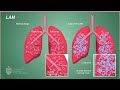 🔴lam lung disease lymphangioleiomyomatosis 💊often people with lam develop a sudden pneumothorax 🩺