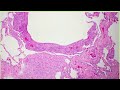 🔴lam lung disease lymphangioleiomyomatosis 💊often people with lam develop a sudden pneumothorax 🩺