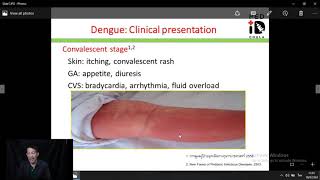 Mini lecture 05 Dengue presentation diagnosis