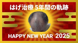 【ハゲ治療 5年目までの軌跡】2025年あけましておめでとうございます