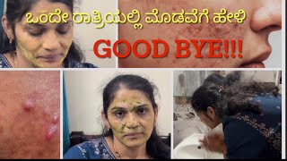 ಒಂದೇ ರಾತ್ರಿಯಲ್ಲಿ ಮೊಡವೆಗೆ ಹೇಳಿ ಗುಡ್ ಬೈ/How to Remove Pimples overnight in Kannada/