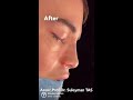 male rhinoplasty before u0026 after