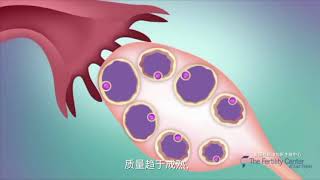 试管婴儿全过程介绍  In Vitro Fertilization Procedure IVF