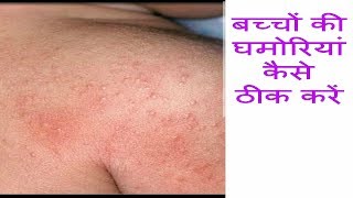 How To Prevent \u0026 Treat Prickly Heat Rashes In Babies || Home Remedies