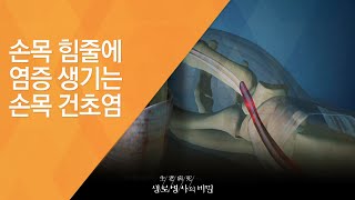 손목 힘줄에 염증 생기는 손목 건초염 - (20141001_519회 방송)_저리고 시리고 쑤시고, 손 건강의 적신호