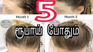 5 ரூபாய் போதும் முன் நெற்றியில் புதிதாக முடி வளர|hair growth in forehead|hair growth tips in tamil