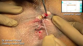Live Unedited Laser Surgery For Fistula Piles Polyp by Ashwin Porwal Healing Hands Clinic Pune India