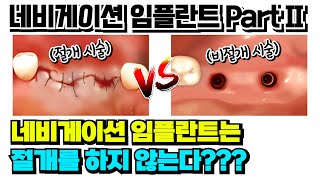 네비게이션 임플란트 Part II - 네비게이션 임플란트는 절개를 하지 않는다???