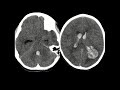 Arteriovenous Malformation