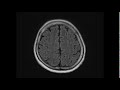 stec hemolytic uremic syndrome hus and encephalopathy