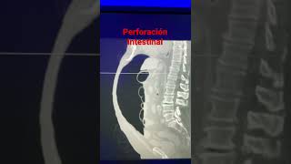 Perforación Intestinal #enarm #imagenologia