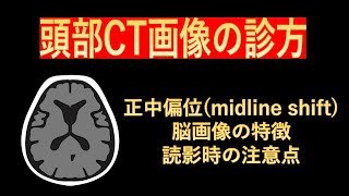 頭部CT画像の診方-頭蓋内圧亢進や脳ヘルニアにつながる正中偏位（midlone shift）-