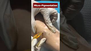 Micro pigmentation treatment at skinaa clinic | Viral #shorts