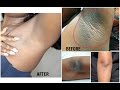 HOW TO LIGHTEN DARK UNDERARM NATURALLY AND FAST | PERMANENT RESULTS HOW TO LIGHTEN DARK UNDERARM NATURALLY AND FAST | PERMANENT RESULTS