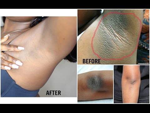 HOW TO LIGHTEN DARK UNDERARM NATURALLY AND FAST | PERMANENT RESULTS HOW TO LIGHTEN DARK UNDERARM NATURALLY AND FAST | PERMANENT RESULTS