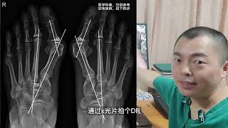 拇外翻后续发展，拇外翻会不会发展关节脱臼？hallux valgus