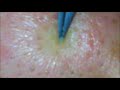 柔らか角栓 limp blackhead 【閲覧注意】