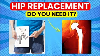 Questions You MUST Ask Before Having A Hip Replacement