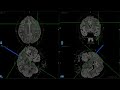 Transsulcal Resection of a Motor Cortex Cavernous Malformation