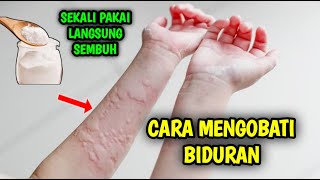 Cara Menyembuhkan Biduran ( Cara Mengobati Biduran )