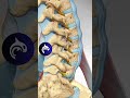 see how a tlif relieves back pain and restores spinal stability with a 3d animation.