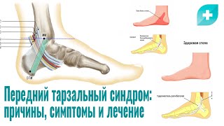 Передний тарзальный синдром: причины, симптомы и лечение