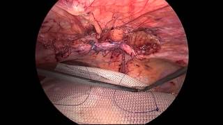 V063 LAPAROSCOPIC REPAIR OF MORGAGNI-LARREY HERNIAS