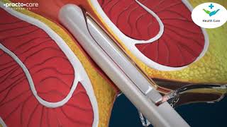 3D animation Vedio laser surgery #piles #hemorroidas #bawaseerkailaj #lasersurgery