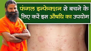 फंगल इन्फेक्शन (Fungal Infection) से बचने के लिए करें इस औषधि का उपयोग || Swami Ramdev