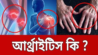আর্থ্রাইটিস কি ? | Arthritis | Bangla News | Mytv News