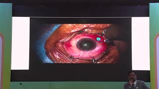 AIOC2020 GP028 T5 Dr Vishali Gupta Chorio Retinal Biopsies