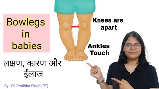 Bow legs in babies in hindi