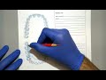 mandibular class i rpd design step by step guide to surveying u0026 drawing on casts and paper