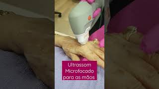 Ultrassom Microfocado para bioestímulo de colágeno nas mãos #ultrassommicrofocado #mãos