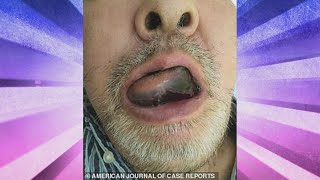 A Massive Tongue Hematoma Sends Man to the ER