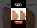 BEFORE & AFTER BUNION SURGERY 😱 PERFECT 🥰 #shorts #beforeandafter