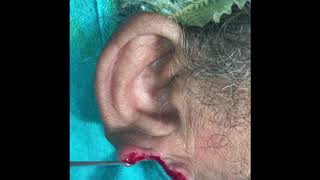 Torn ear lobe repair - Otoplasty by Dr Sunil Richardson