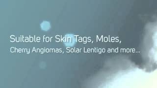 CryoPen Skin Tags