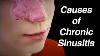 Causes of Chronic Sinusitis (Anatomic Factors, Biofilm, Abnormal Microbiome)