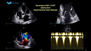 Spring Ultrasound Knowledge Booster #2: Secondary SAM Phenomenon – What is it?