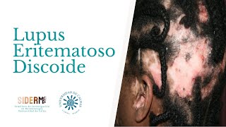 Revisión Lupus Eritematoso Discoide