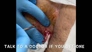 Draining Perianal Abscess