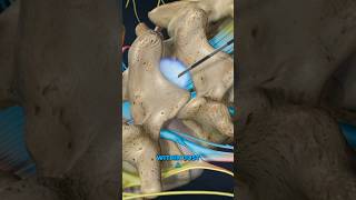 Lumbar Epidural Steroid Injection (3D Animation)