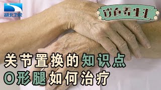 关节置换的知识点,O形腿治疗要趁早,65岁以下才建议做手术【饮食养生汇】