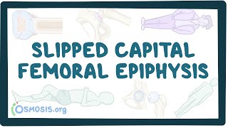 Slipped capital femoral epiphysis - an Osmosis Preview