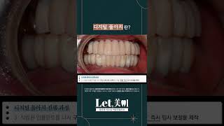 디지털 풀아치란?#임플란트후기#당뇨환자임플란트#당일임플란트