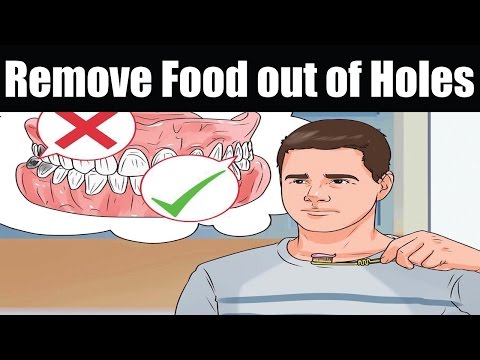 How to Remove Food out of Holes from Extracted Wisdom Teeth How to Remove Food out of Holes from Extracted Wisdom Teeth