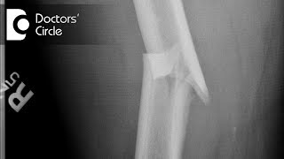 How long does it take to recover from a Complex fracture? - Dr. Gururaj S Puranik