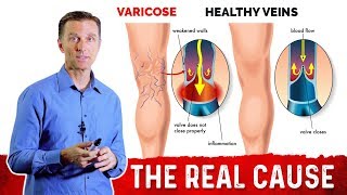 What Causes Varicose Veins \u0026 How To Get Rid Of It? – Dr. Berg