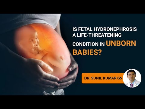 How early can fetal hydrops be detected?